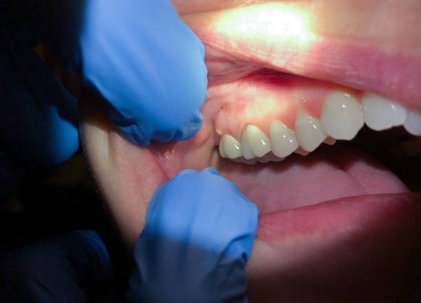Best Emergency Dental Care for Sports Injuries in Nroe City, MO
